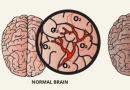 Nestacha kiselost u mozgu djeteta, simptomi i oporavak