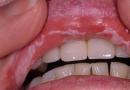 Razlozi za pokazivanje bijele nalote na usnama odraslih
